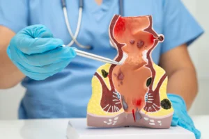 Bladder Cancer Treatment Options and When to Seek Medical Help