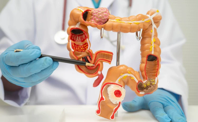 Colon Cancer vs Rectal Cancer: Treatment Differences