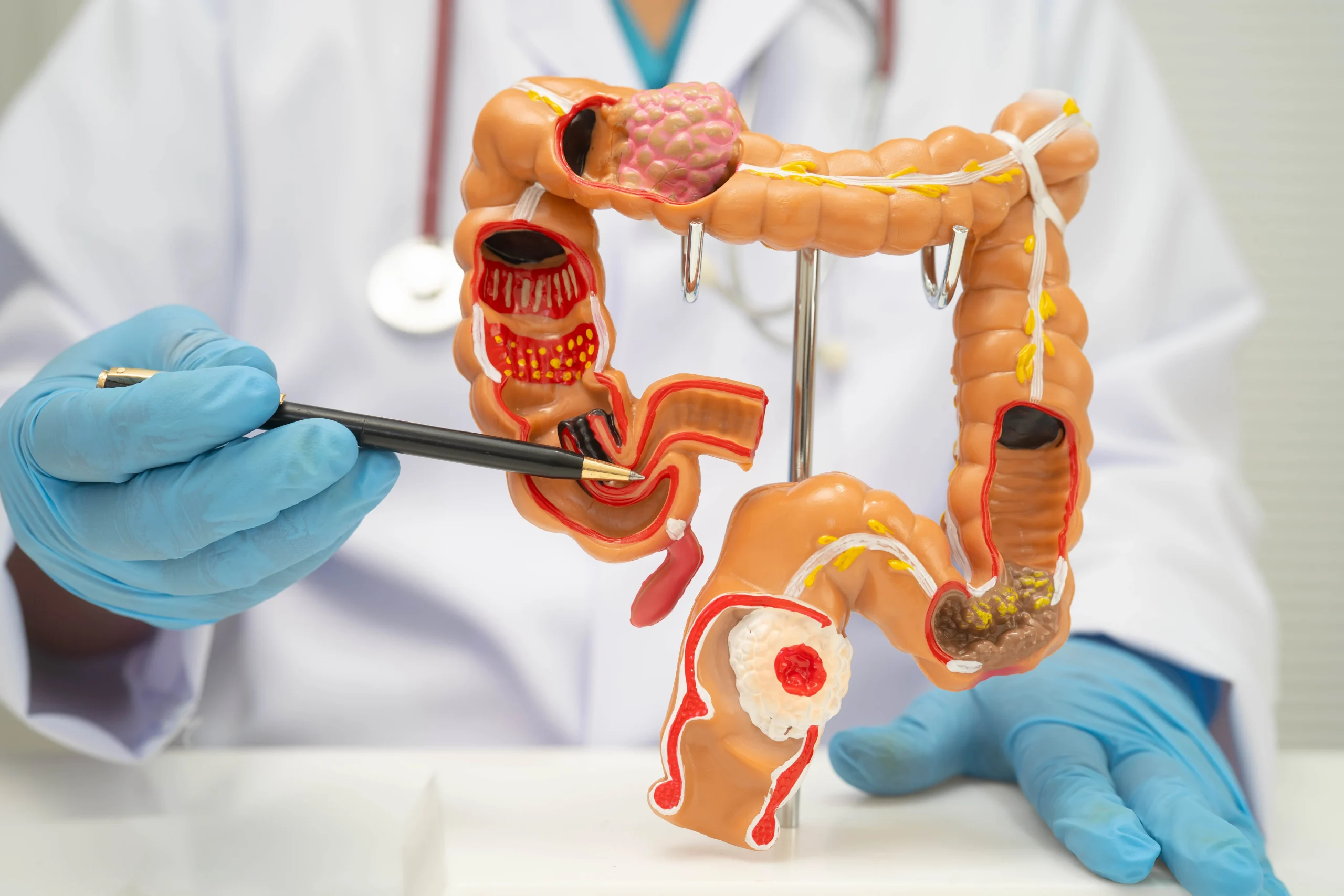 Colon Cancer vs Rectal Cancer